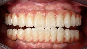 Latest company case about Customer Case | 4D Zirconia Block