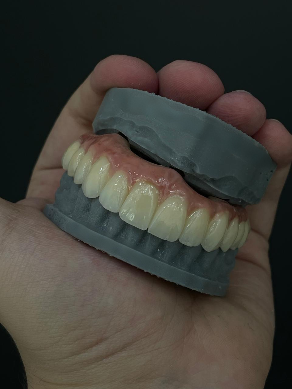 Latest company case about Achieving Natural Esthetics with Zirconia: A Successful Full-Arch Restoration Case from Brazil