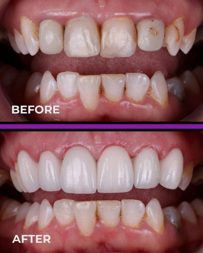 CAD CAM Milling Dental PMMA Block PMMA Disc For Dental Laborotory