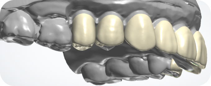Digital Veneer Restoration Workflow: How CAD/CAM Technology Improves ...