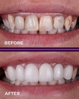 CE 49% Transmittance Zirconia Blocks Dental Discs For Aesthetic Restoration