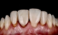 ST Preshade Dental Zirconia Disc 71mm Dental Cad Cam Milling System