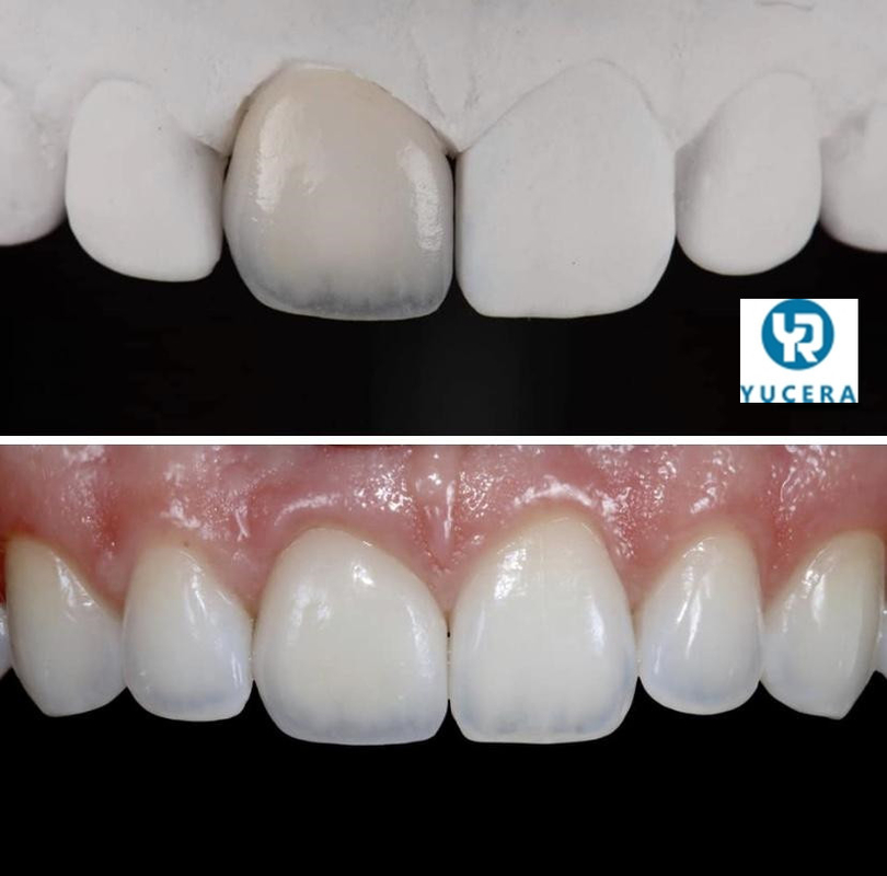 98 95 System 3d Pro Plus Multilayer Zirconia Dental Blocks Vita 16 Color